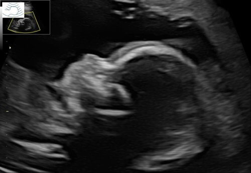Ultraschallbild eines Fötus im Profil