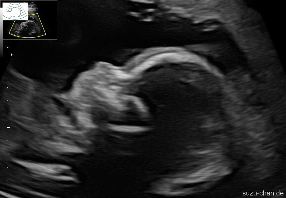 Ultraschallbild eines Fötus im Profil